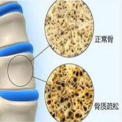 【骨密度分析儀科普】骨密度指標(biāo)對(duì)照表，人手一份